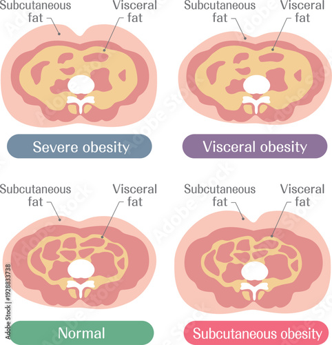 Obesity Levels and Fat Types Severe Visceral and Subcutaneous Illustration