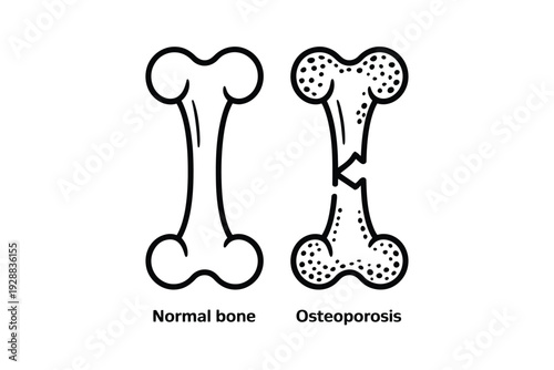 Bone osteoporosis illustration showing normal and affected bones