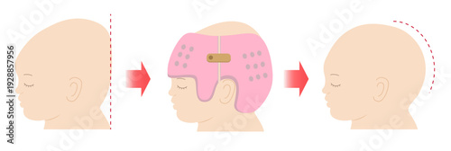 ヘルメット治療による赤ちゃんの頭蓋矯正の仕組みを示したビフォーアフター比較図