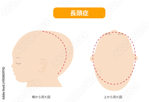 長頭症、横と真上から見た頭の形に歪みがある長頭症の赤ちゃんのイラスト