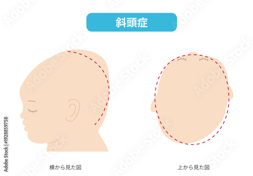 斜頭症、横と真上から見た頭の形に歪みがある斜頭症の赤ちゃんのイラスト