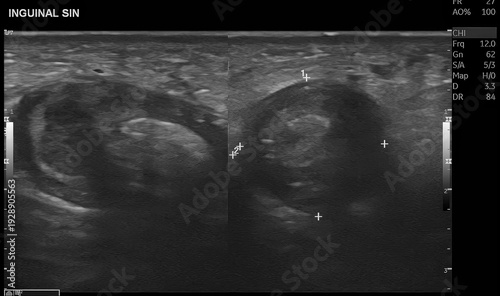 Fotografía Scrotal ultrasound with color Doppler evaluation demonstrates features suggestive of inguinoscrotal hernia with associated vascular compromise, raising suspicion for testicular torsion