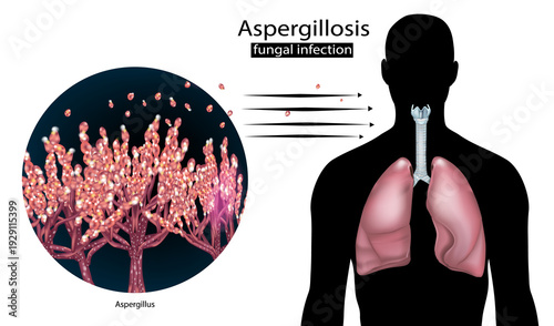 Φωτογραφία Aspergillosis Fungal Infection Detailed Medical Illustration with Aspergillus Spores and Human Lungs Anatomy