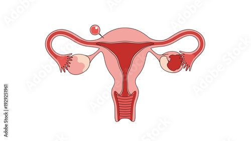 Medical illustration showing the female reproductive system including the uterus and ovaries with a focus on abnormal growths or cysts.