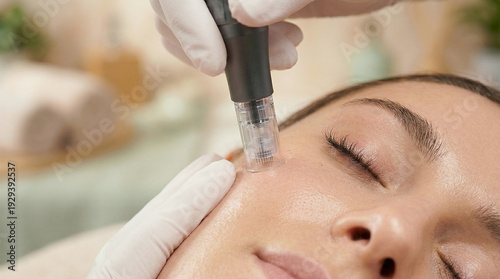Professional Microneedling Facial Treatment using Electronic pen on Woman's Cheek for Skin Rejuvenation and Anti-Aging in Aesthetic Clinic
