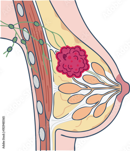 Clear medical illustration of breast cancer pathology, depicting a malignant tumor in the mammary gland with affected lymph nodes, important for education and awareness