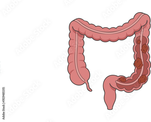 Illustration of the human colon with polyps, depicting a health issue