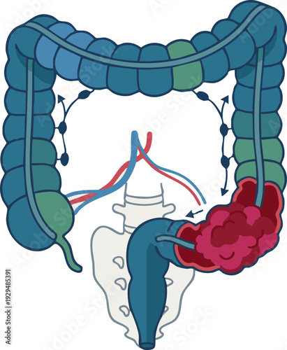 Detailed anatomical illustration of the human large intestine with a cancerous tumor, depicting colorectal disease and the intricate digestive system