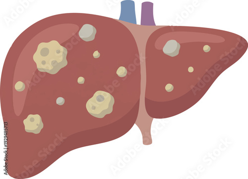 Illustration of a human liver with multiple large tumors, symbolizing liver disease and cancer