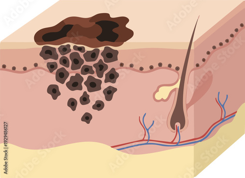 Medical illustration showing advanced skin cancer, depicting melanoma cells spreading from the epidermis into deeper dermal layers, illustrating disease progression and pathology