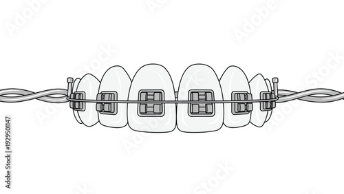 Row of white teeth is shown fitted with metallic dental braces and a wire for orthodontic alignment and correction.