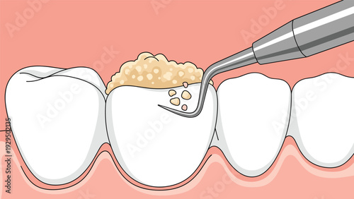 Dental tool removing tartar and plaque from a human tooth to demonstrate professional oral hygiene and teeth cleaning.