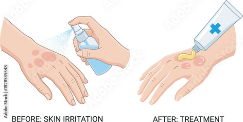 Medical illustration showing a hand with skin irritation before and after treatment using spray and ointment, highlighting dermatology care, healing process, and skincare improvement