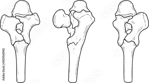 Views of the human hip joint anatomy with femur and pelvis bones in line style
