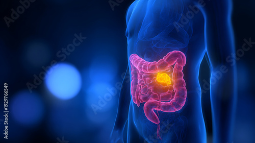 3D Render of Human Colon with Lesion – Abstract Medical Illustration of Digestive System Anatomy and Disease, Healthcare Concept