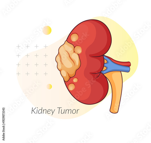 Kidney Tumor a Abnormal Growth - Stock Illustration