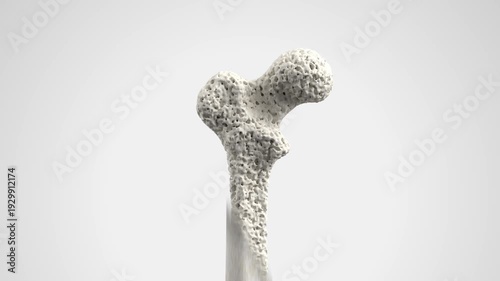 Osteoporosis Bone Structure 3D Medical Animation