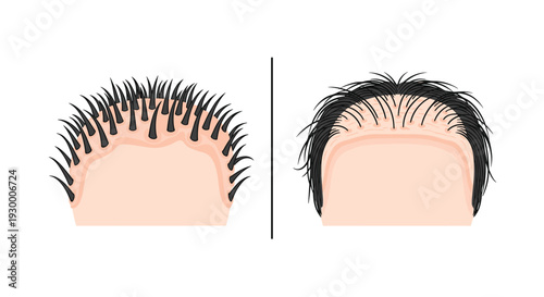 An anatomical illustration displays the difference between initial hair follicle grafts and a more natural distribution of hair after a transplant procedure.