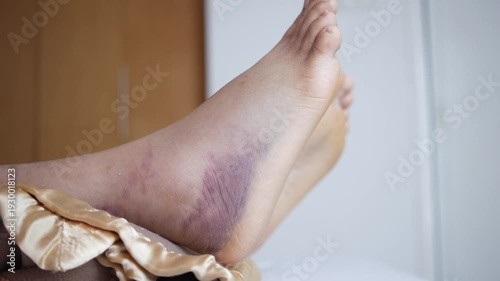 Bruised and swollen ankle with purple hematoma after sports injury on Caucasian skin