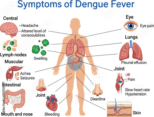 Symptoms of Dengue Fever Medical Infographic