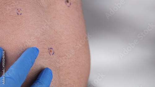 Φωτογραφία Dermatologist in blue gloves examines a marked mole on a hairy male torso during skin cancer screening and plastic surgery consultation