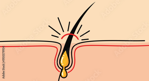 Medical diagram showing a hair follicle with an inflamed red area and yellow oil or pus buildup, representing an ingrown hair or acne.