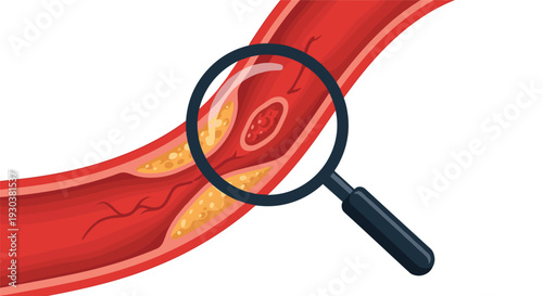 Close up through magnifying glass showing blocked artery with cholesterol plaque buildup and red blood cells in blood vessel.