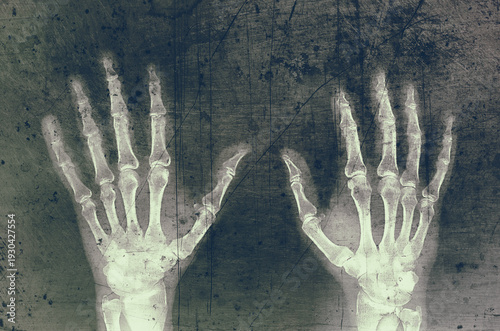 Röntgenbild zweier Hände, Fotomontage