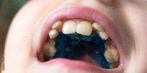Open mouth, view of plate on upper jaw, orthodontic appliance for expansion and bite correction in child.