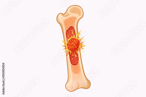 Illustration of a bone with a tumor growing inside the marrow cavity