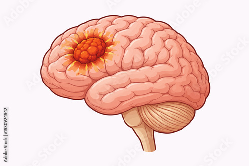 Illustration of a human brain with a prominent tumor growing inside its cerebral cortex