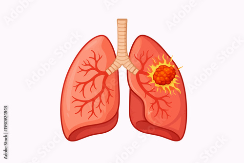 Illustration of a lung with a tumor, representing lung cancer and respiratory disease