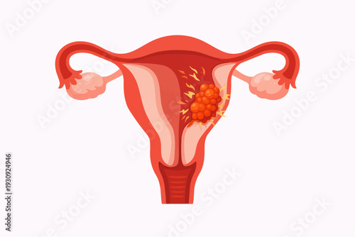 Illustration of a uterus with a tumor or fibroid growth inside the uterine wall