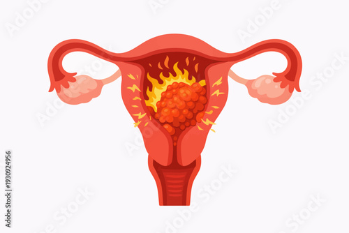 Illustration of a uterus with fibroids and inflammation, representing pain and discomfort