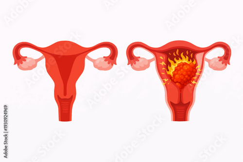 Uterus with Fibroid Tumor and Inflammation Compared to Healthy Uterus