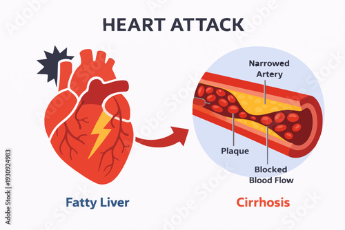 Understanding Heart Attack: Fatty Liver and Cirrhosis Connection Explained Visually