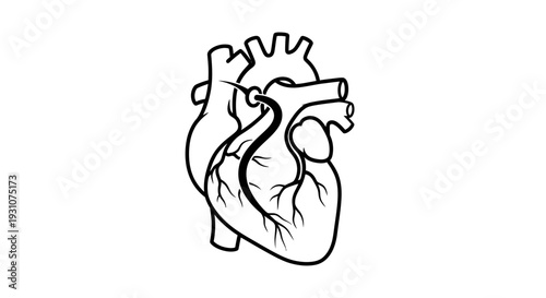 Detailed outline of human heart anatomy illustrating a catheter medical intervention process
