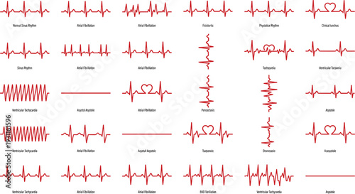 Electrocardiogram ECG Heart Rhythm Collection, Cardiac Arrhythmia Patterns Including Atrial Fibrillation, Ventricular Tachycardia and Asystole Medical Illustration