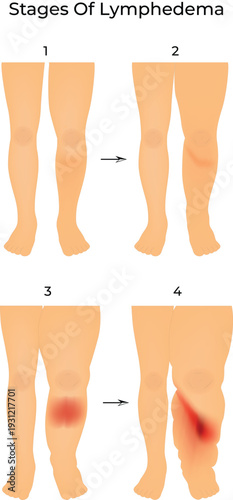 Stages of Lymphedema Progression Diagram