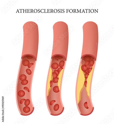 Normal artery compared to an artery damaged by atherosclerosis