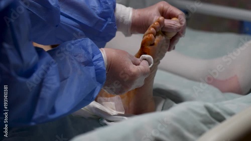 Doctor Cleaning Diabetic Foot Ulcer with Sterile Gauze. Medical Treatment of Chronic Diabetic Foot Wound. Diabetes treatment