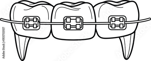 Teeth with Metal Braces Orthodontic Treatment