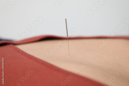 Tableau sur toile Séance de massage par acupuncture sur un patient
