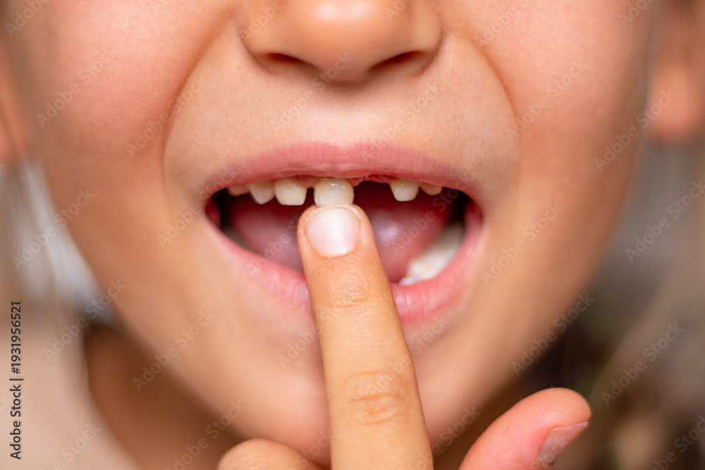 Naklejka premium Child showing loose baby tooth with finger pointing at it, mouth open, revealing gap between teeth, close-up view of dental situation and oral health