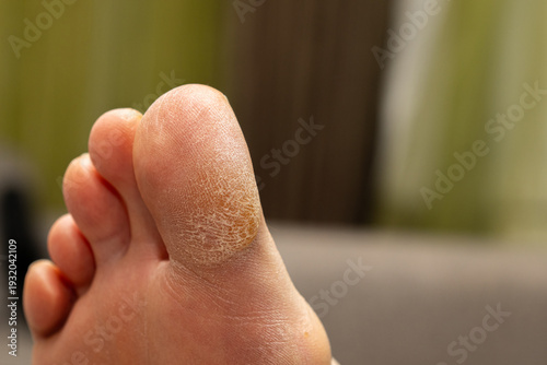 Bild auf Leinwand Close-up view of the flaky and thickened skin layer on the toe