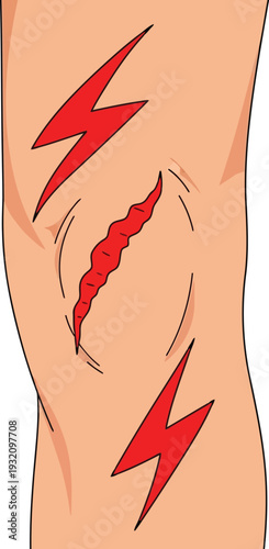 Vector illustration of knee injury with scar and pain symbols for medical and healthcare concepts