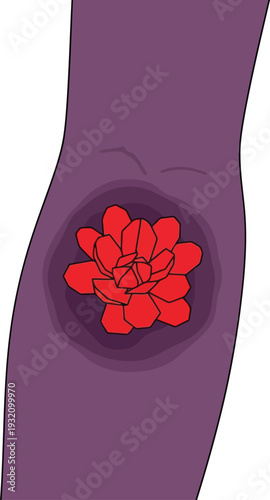 Vector illustration of skin ulcer with red inflamed wound on purple background for medical education