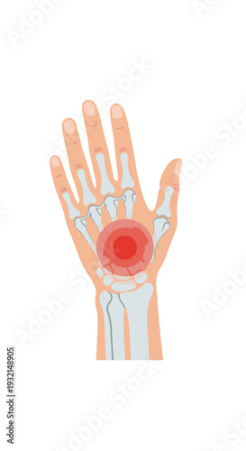 A human hand is illustrated palm-up with visible bones, showing a red highlighted area of pain in the central palm and wrist.