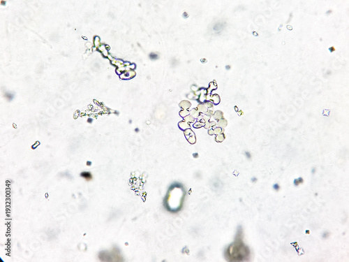 Calcium oxalate monohydrate, pus cells in urine under microscope.