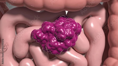 Ultra-Realistic Scientific 3D Visualization of Intestinal Cancer – Static Human Intestine Anatomy with Cinematic Camera Motion